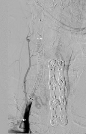 angio R vert stent.jpg